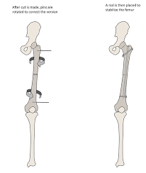 fem osteotomy anteversion