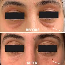 rejuvenate tired eyes without surgery