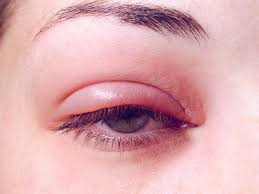 are you suffering from eye stye know