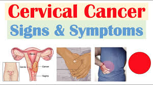 cervical cancer signs symptoms why