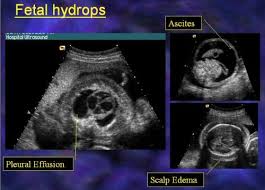 Ultrasound Interactive Case Study  Myoma   OBGYN Net      