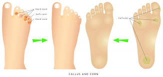 Lump on achilles tendon, right side, no pain. Foot Corns Calluses Cysts Treatment Homer Glen And New Lenox Il