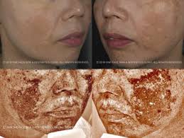 melasma treatment singapore dr david