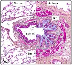Caught without an inhaler during an asthma attack? Il 13 Asthma And Glycosylation In Airway Epithelial Repair Intechopen