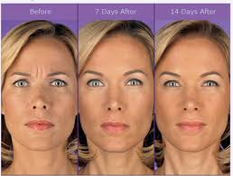 botox cosmetic is the leading