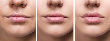 a guide to lip fillers before and after