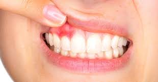 the gums gingivitis or periodonis