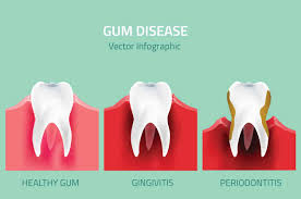 gum disease denver periodontal