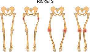 rickets