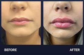 lip filler before after pictures