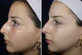 laser away your acne scars