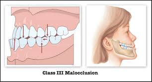 Angle's Classification - Class 3 Malocclusion