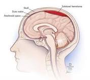 Image result for icd code for subdural hematoma