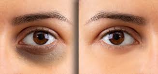 How To Get Rid Of Dark Circles : Causes and Treatment | Strength Buzz