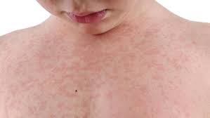 Terdapat sejumlah penyakit lain yang dapat menimbulkan gejala bintik merah seperti campak. 4 Penyakit Kulit Yang Mengintai Saat Musim Hujan
