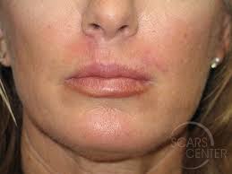 lip reconstruction 3 skin cancer and