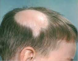 hair to grow back after chemotherapy