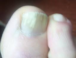 nail fungus information prevention