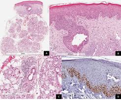 a histopathological aspects in low