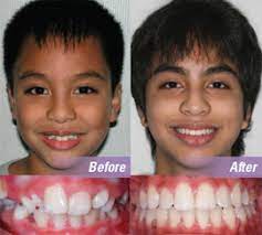 braces individual patient orthodontics