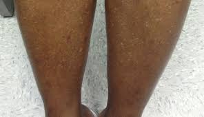 derm dx white spots on the legs