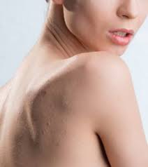get rid of back acne using home remes