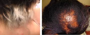 hair breakage causes symptoms