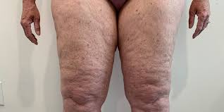 what is lipedema lipedema causes