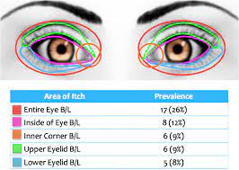 ocular pruritus in the eye adapted