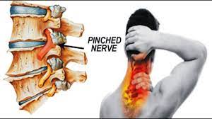 natural remes to fix a pinched nerve