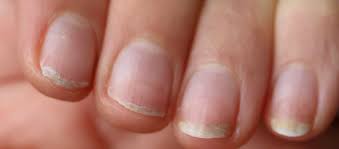 nail changes why they turn brittle in