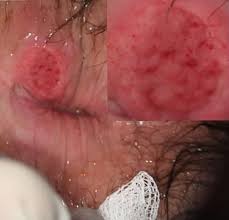 an unusual peri ulcer gkegkes