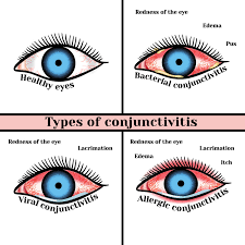 types of red eye oasiseye specialists