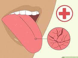 13 ways to soothe a burnt tongue wikihow