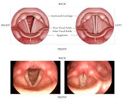vocal papillomas symptoms diagnosis