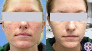 laser treatment for rosacea types