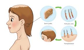 Products used and available using link below: Female Pattern Hair Loss Health