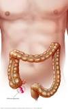 What is the most common cause of appendicitis?