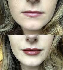 getting 1ml lip filler with flawless