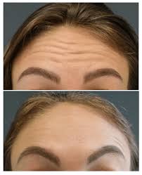 We did not find results for: Botox Beverly Hills