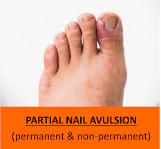 auckland ingrown toenail clinic