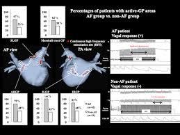 Is Vagal Response During Left Atrial Ganglionated Plexi