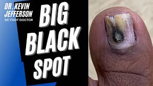 spot unusual fungal toenail