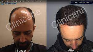clinic for hair transplant in turkey