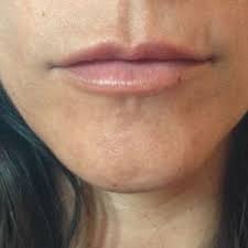 dent above upper lip after juvederm