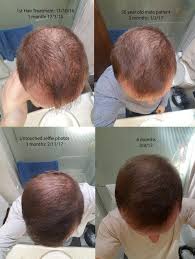acell prp hair regrowth therapy delivers real results