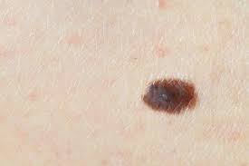 The strongest risk factor for developing skin cancer is ultraviolet (uv) ray exposure, typically from the sun. Nhs On Twitter Do You Know Your Abcde Of Moles Important Information About Preventing Skin Cancer Here Http T Co Wksgaufczg Http T Co Fobvxphxdn