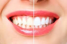 natural teeth whitening options