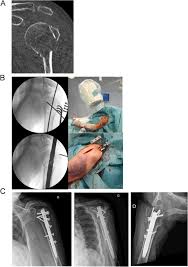 antegrade nailing of humerus fractures