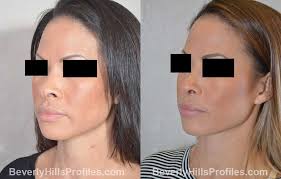 rhinoplasty before after photos